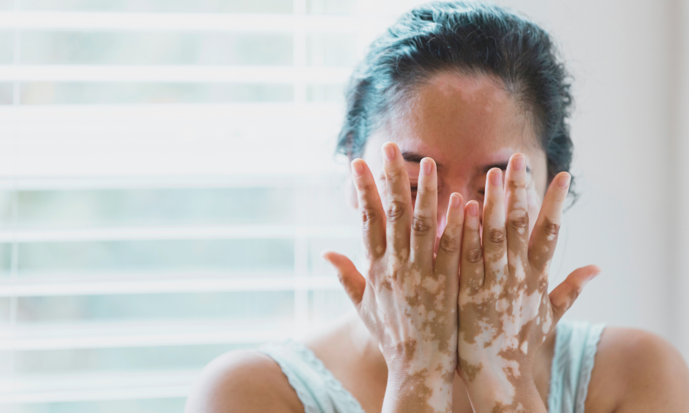 Vitiligo Hände Dauerhafte Haarentfernung made by hairfree für Vitiligo an den Händen