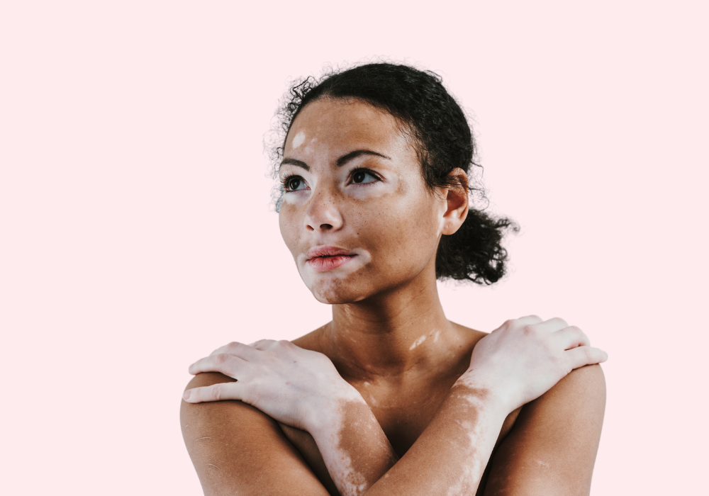 Vitiligo Dauerhafte Haarentfernung made by hairfree für Vitiligo